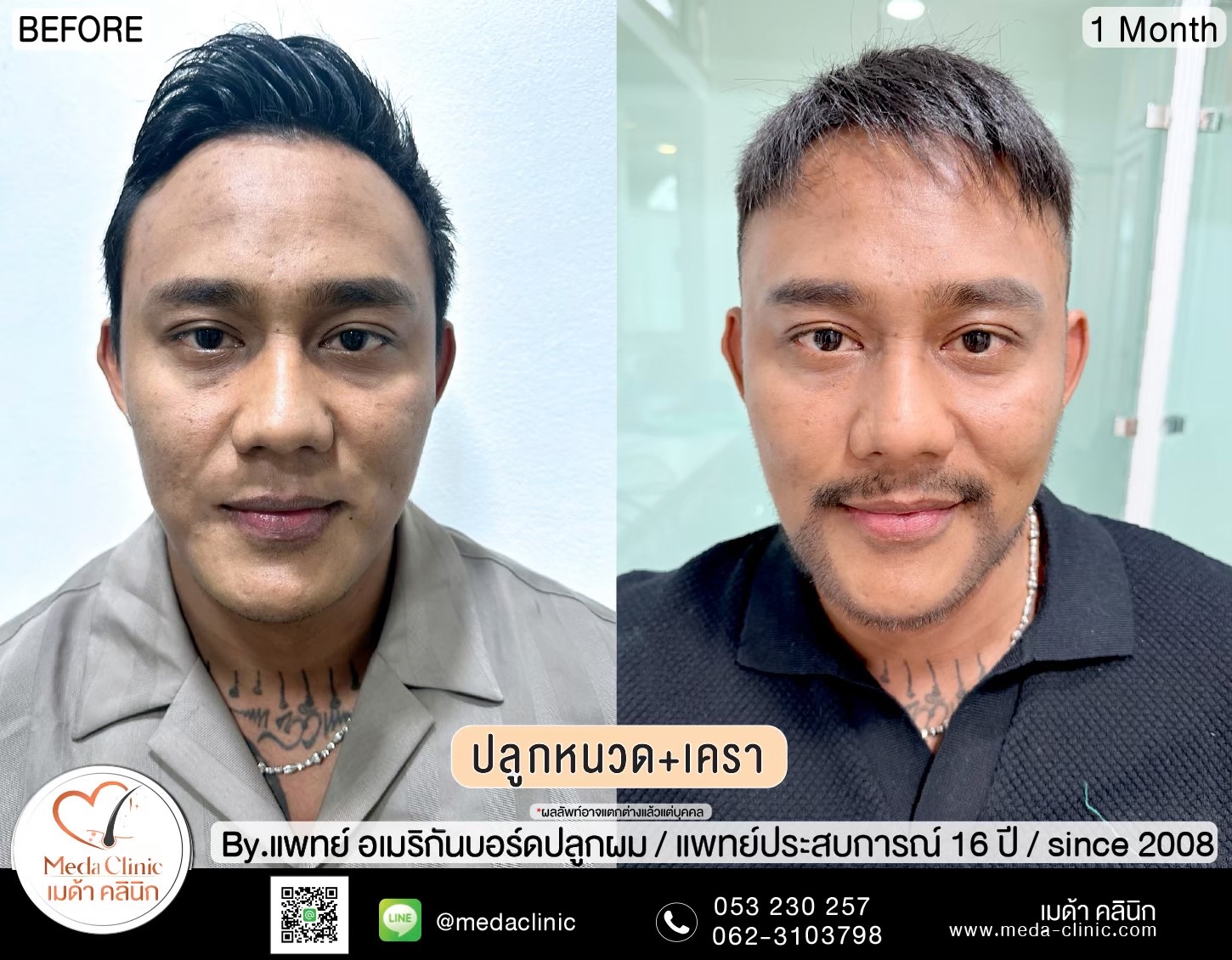 ปลูกหนวดเชียงใหม่