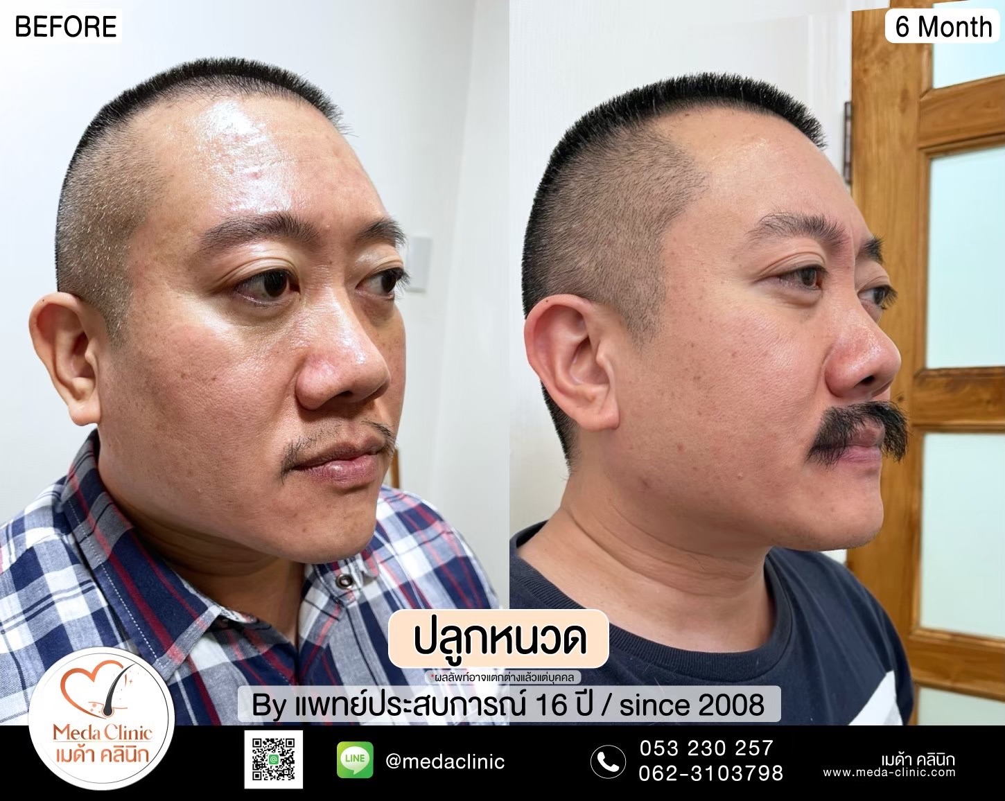 ปลูกหนวดเชียงใหม่