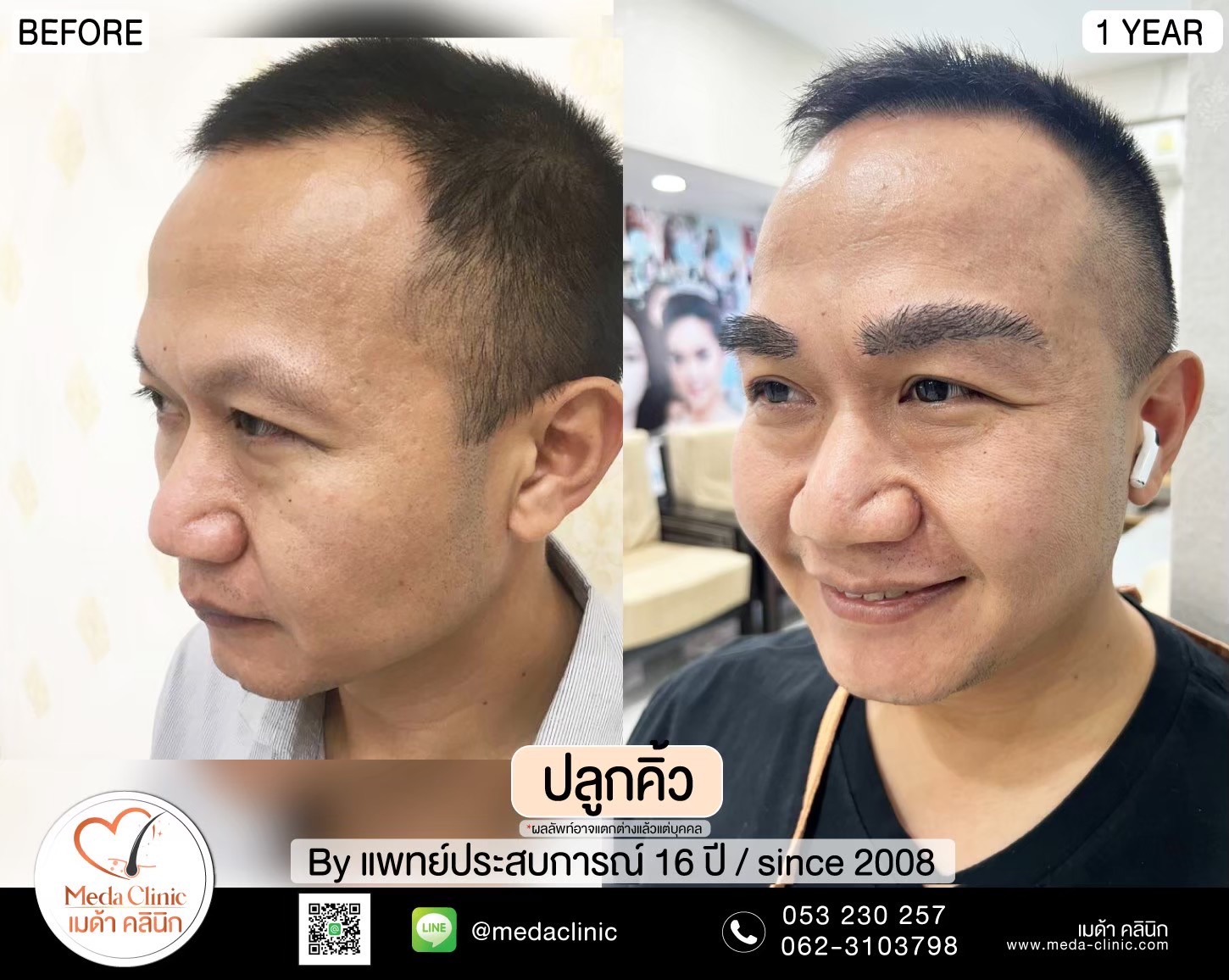 ปลูกหนวดเชียงใหม่