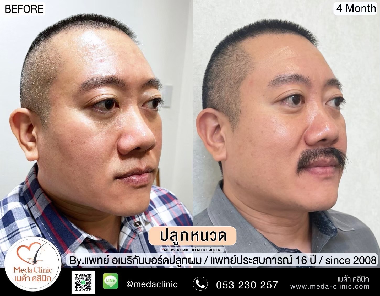 ปลูกหนวดเชียงใหม่