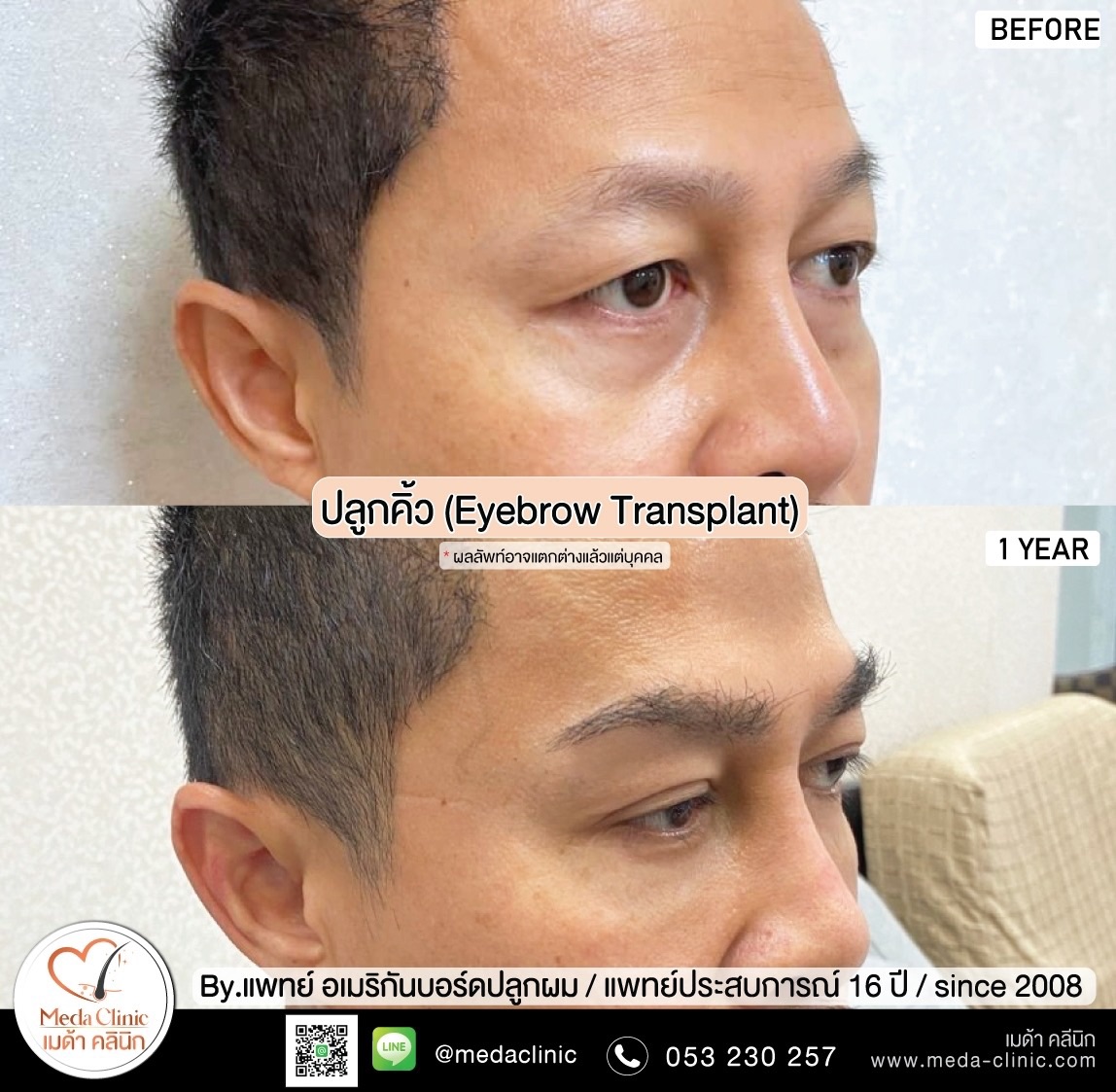 ปลููกคิ้ว