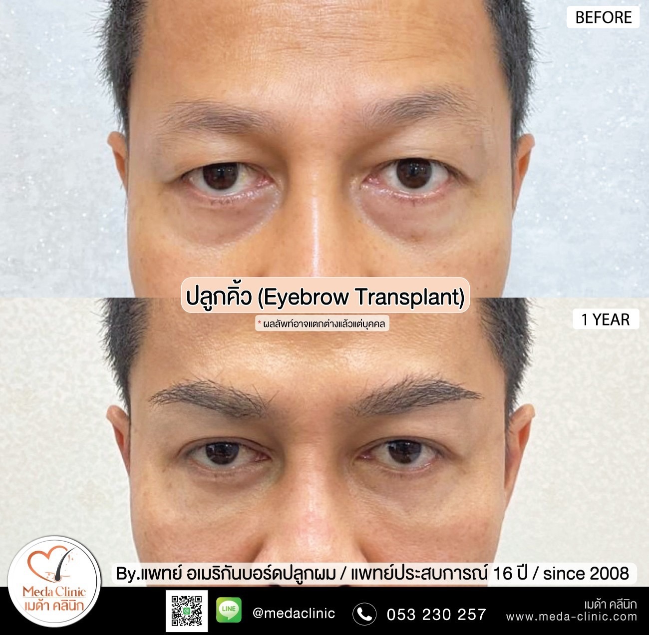 ปลูกหนวดเชียงใหม่