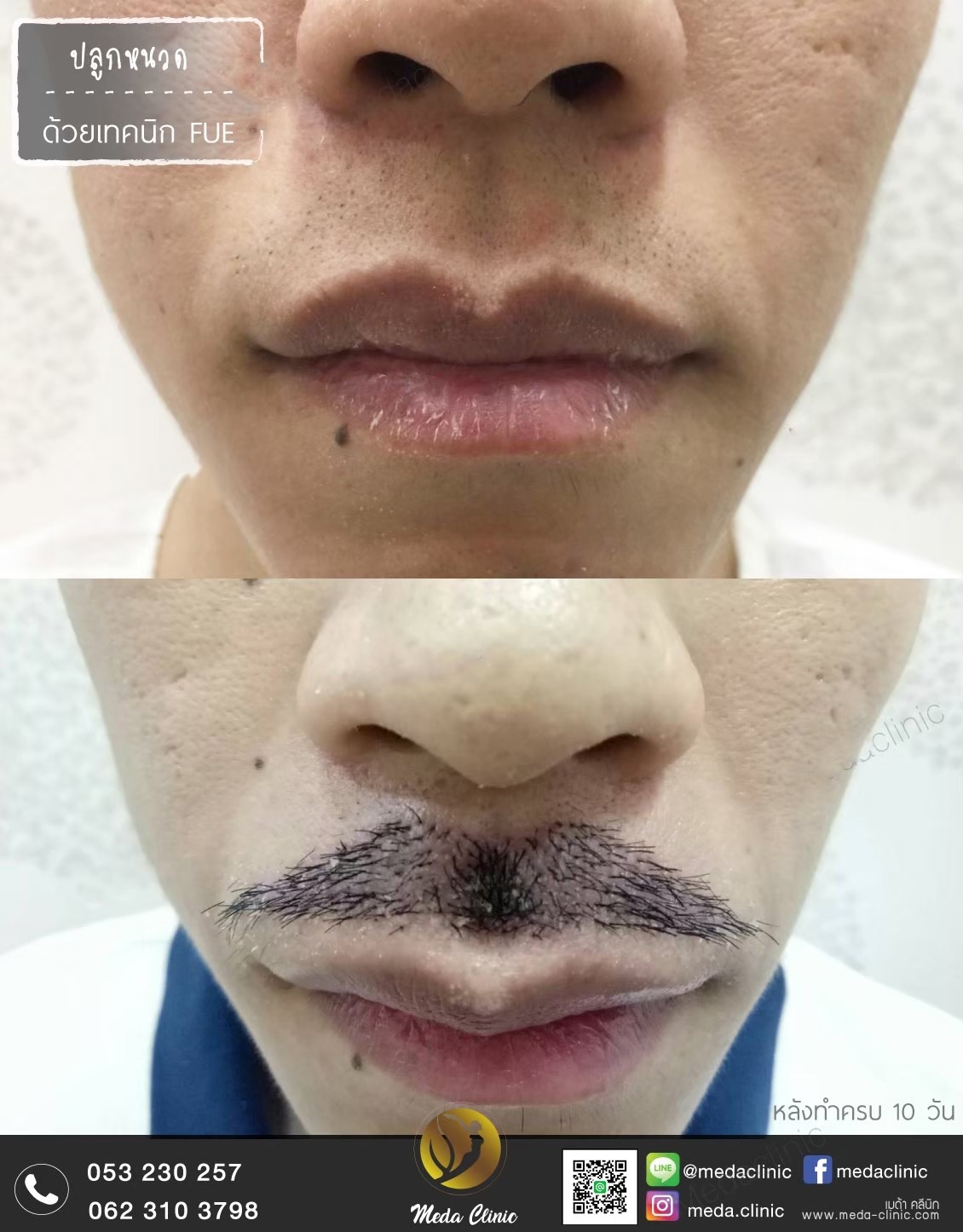 ปลูกหนวดเชียงใหม่