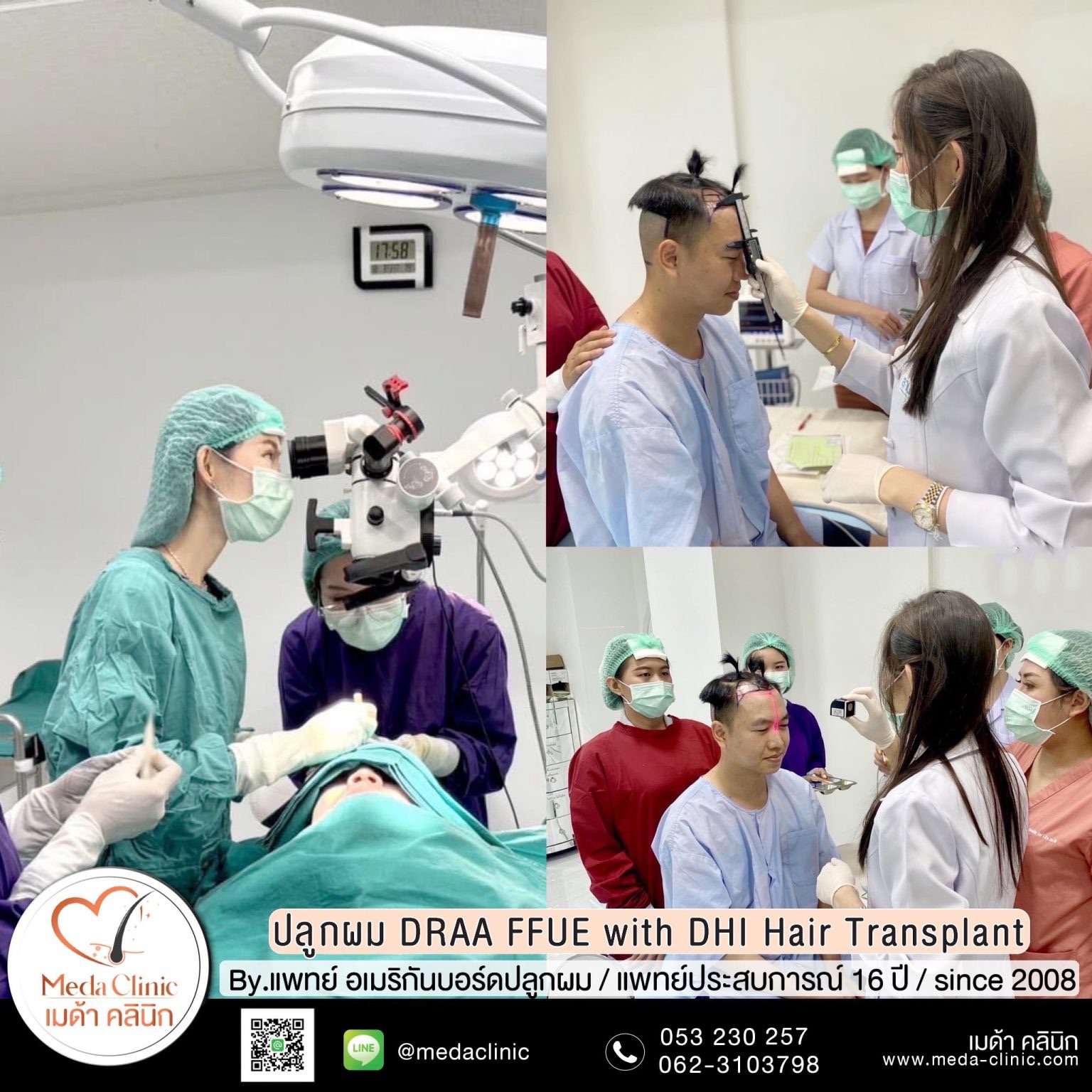 เทคนิกปลูกหนวด