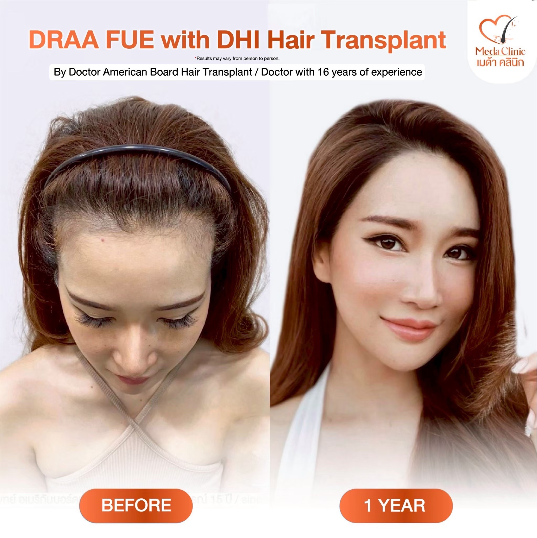 Where is the best hair transplant in Thailand