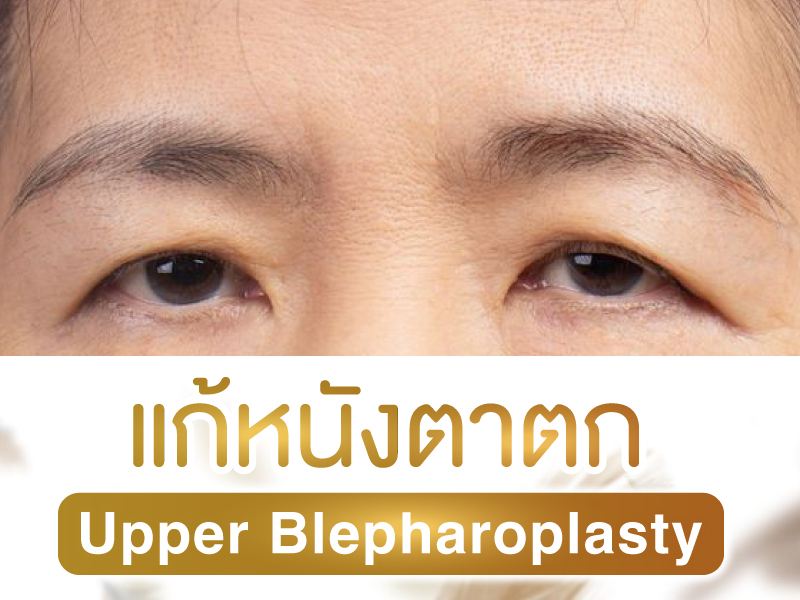 แก้หนังตาตก