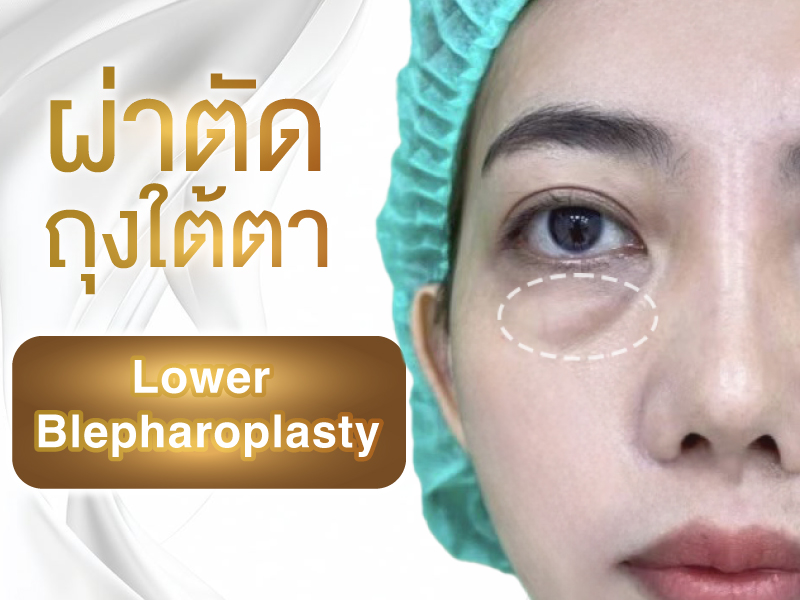 ผ่าตัดใต้ตา