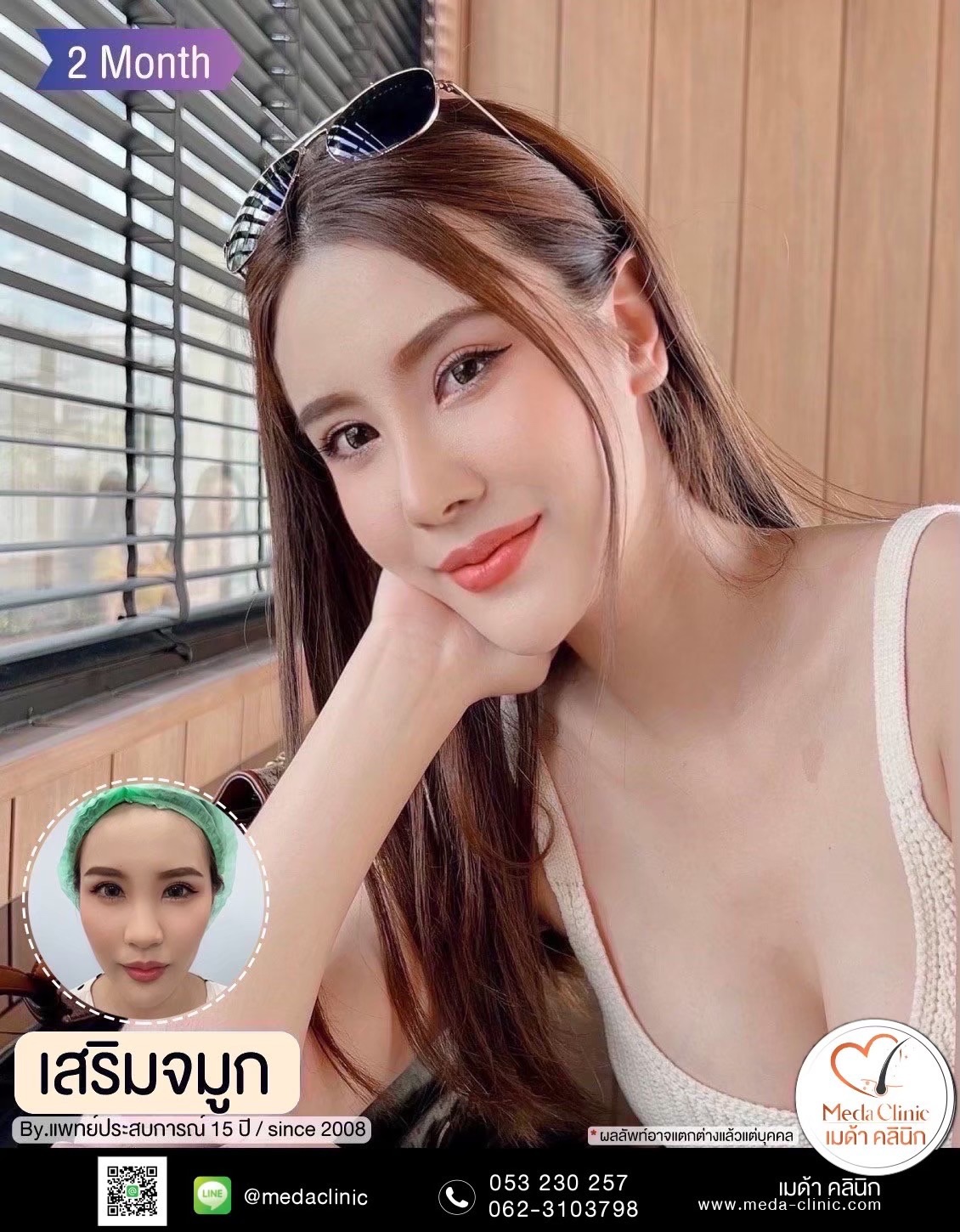 แก้จมูกที่ไหนดี?