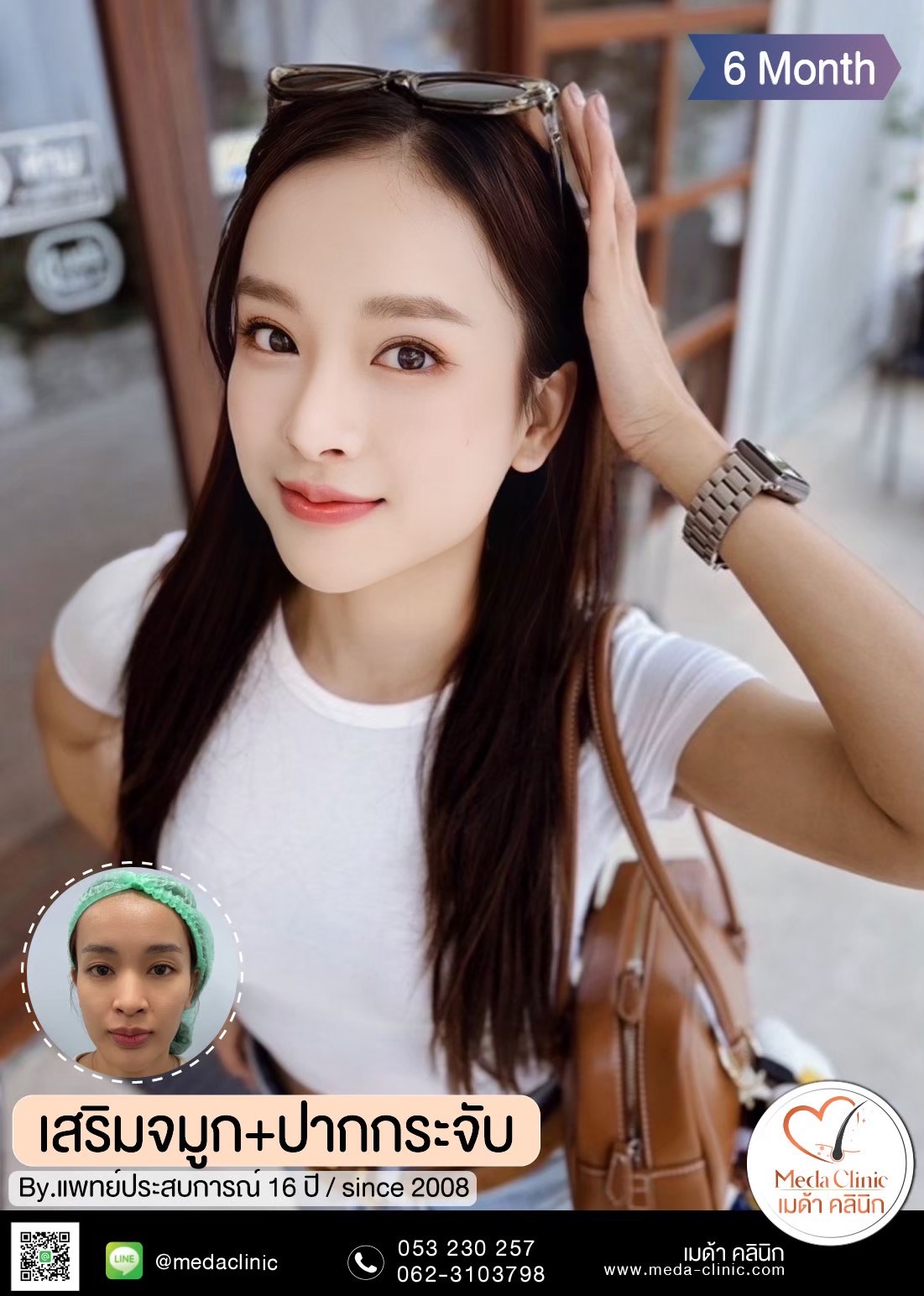 แก้จมูก