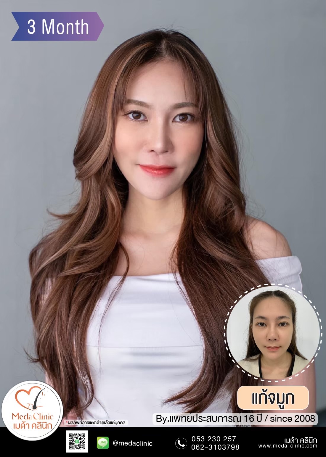 แก้จมูกเชียงใใหม่