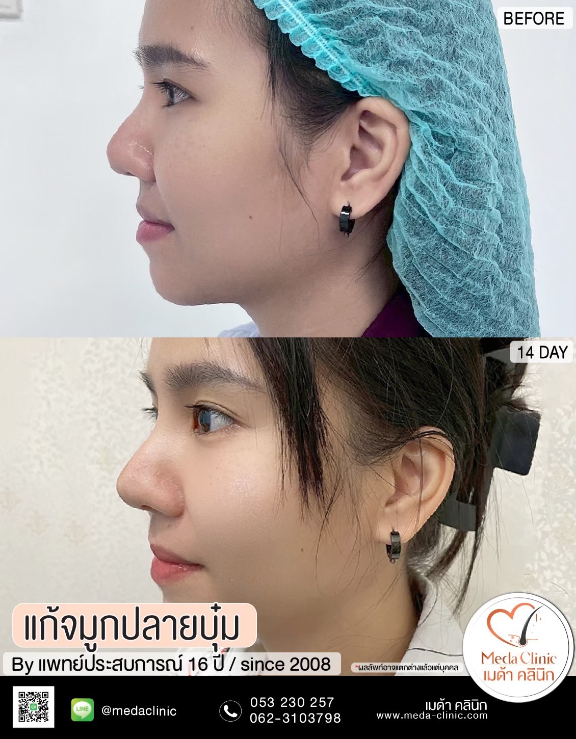 แก้จมูกที่ไหนดี ?