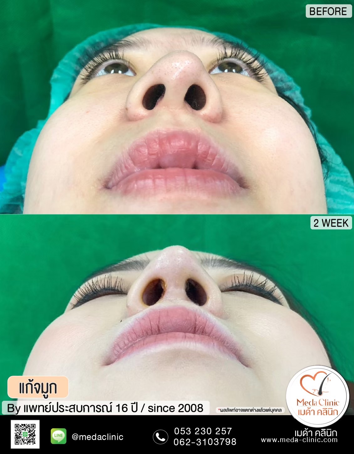 แก้จมูกที่ไหนดี?