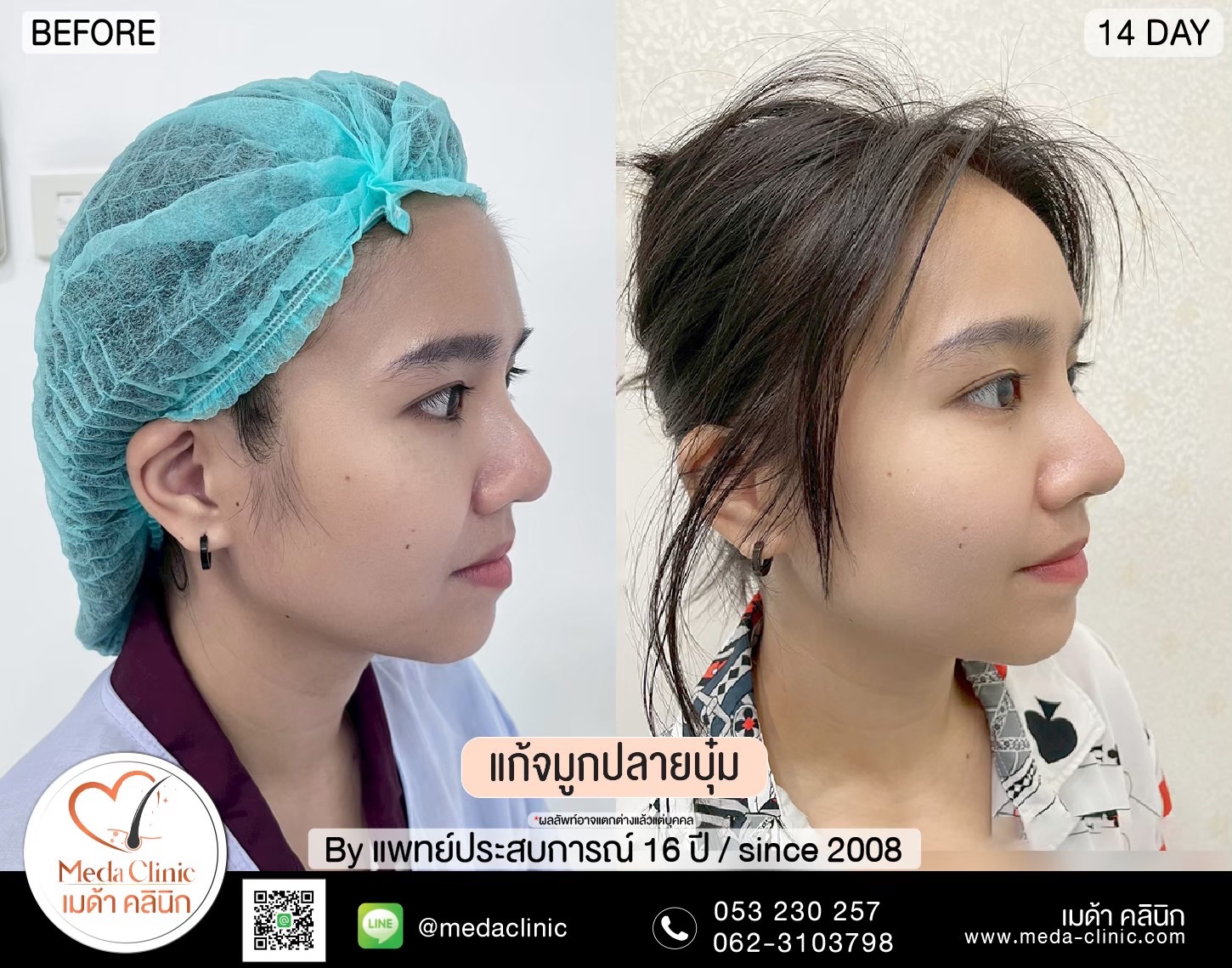 แก้จมูกที่ไหนดี ?