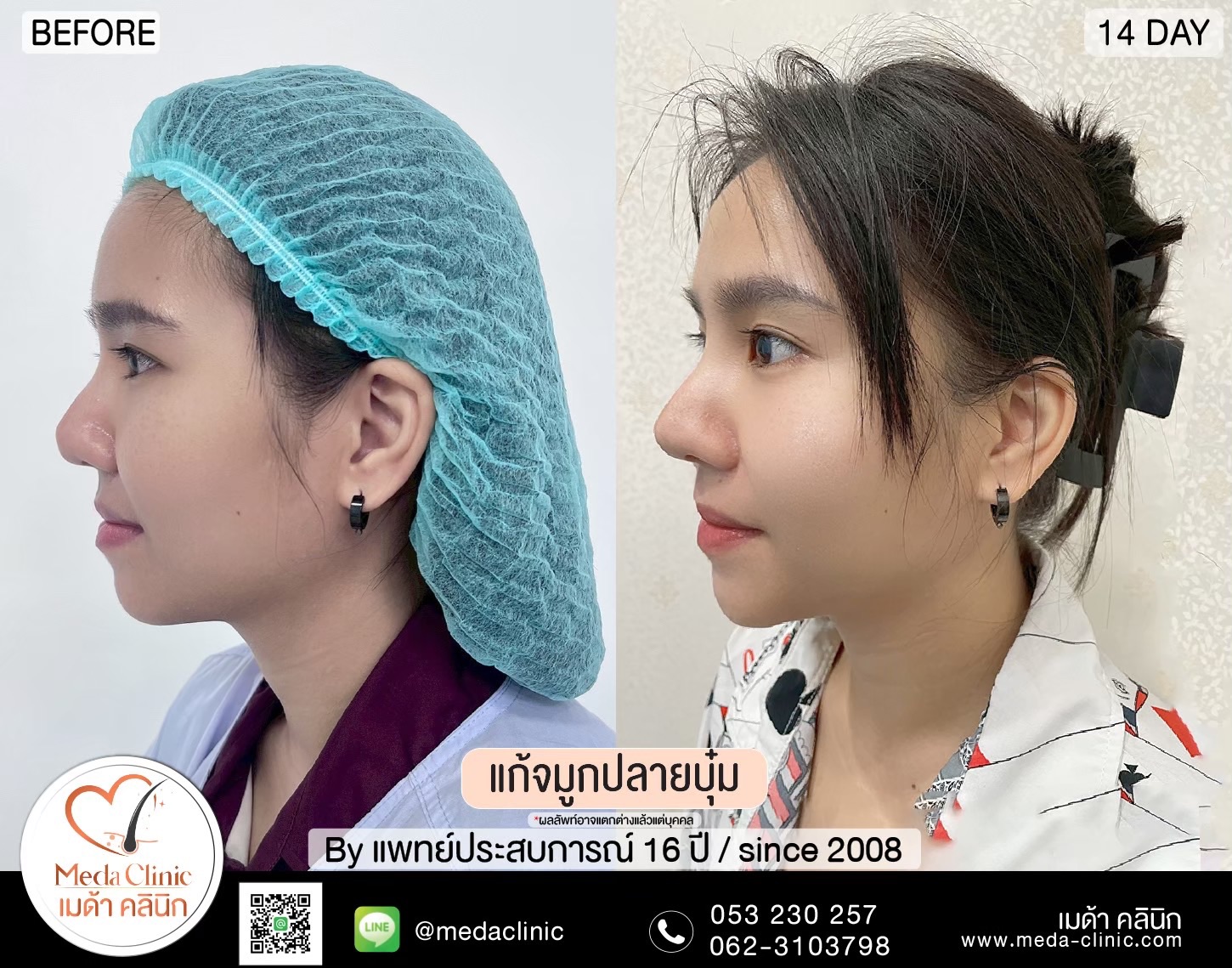 แก้จมูกที่ไหนดี ?