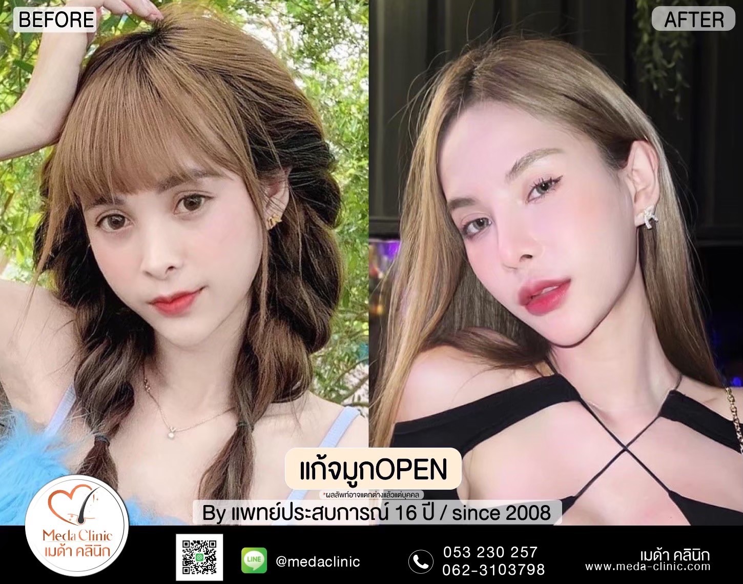 แก้จมูกที่ไหนดี ?