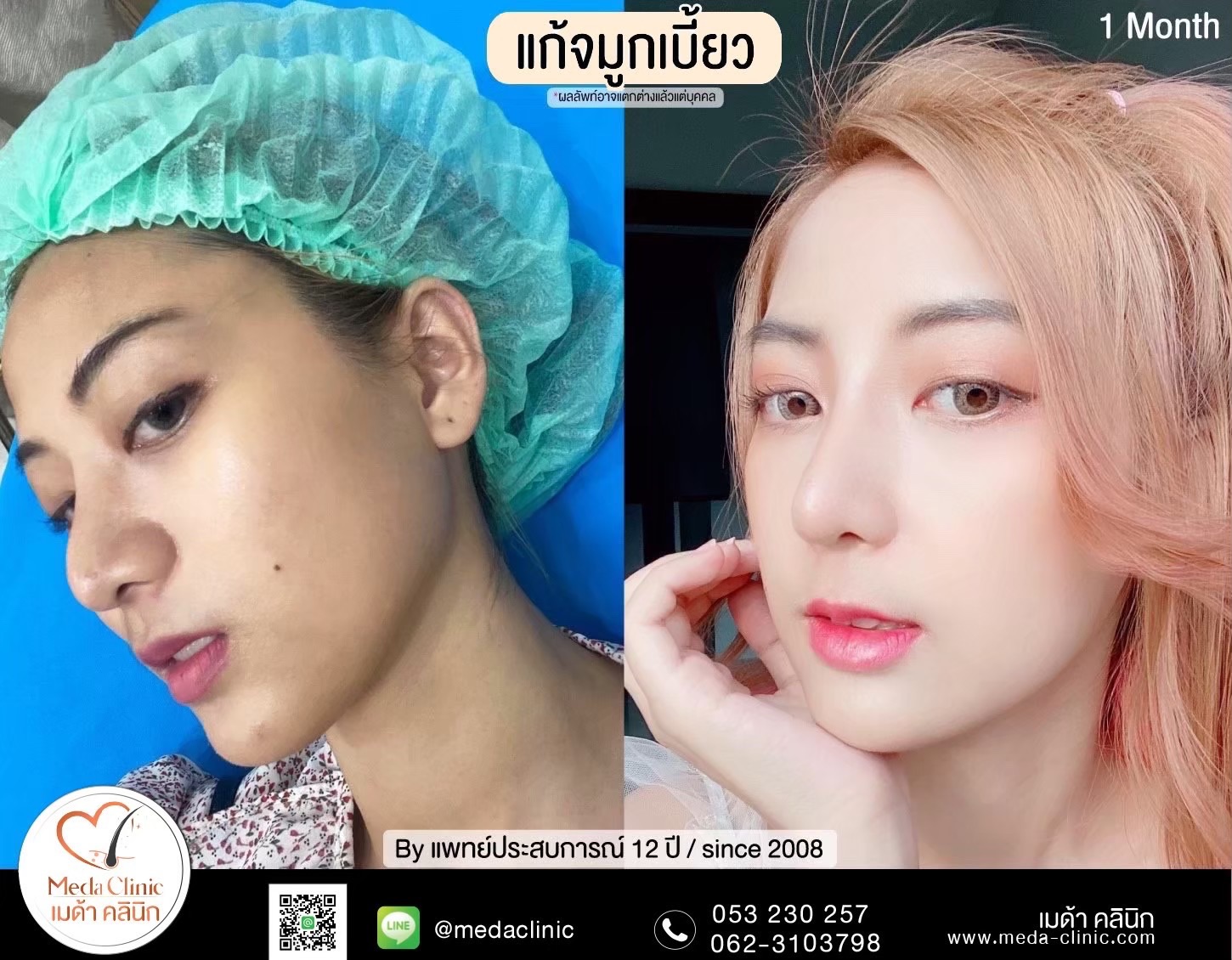 แก้จมูกที่ไหนดี ?