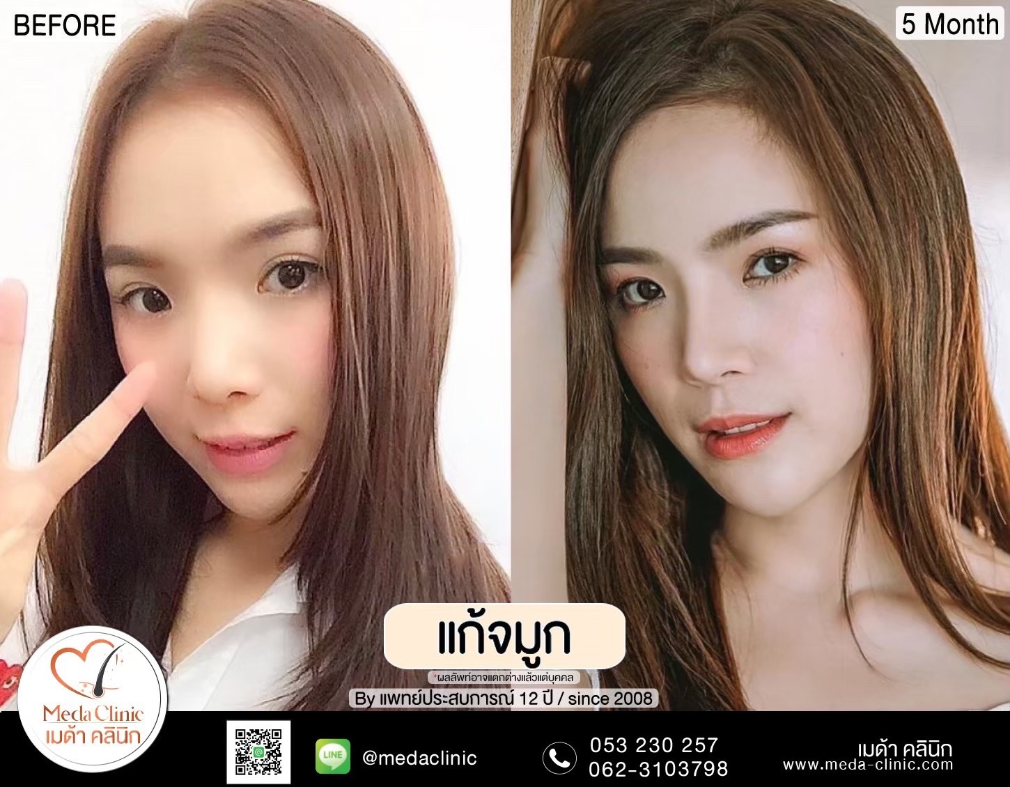 แก้จมูกที่ไหนดี ?