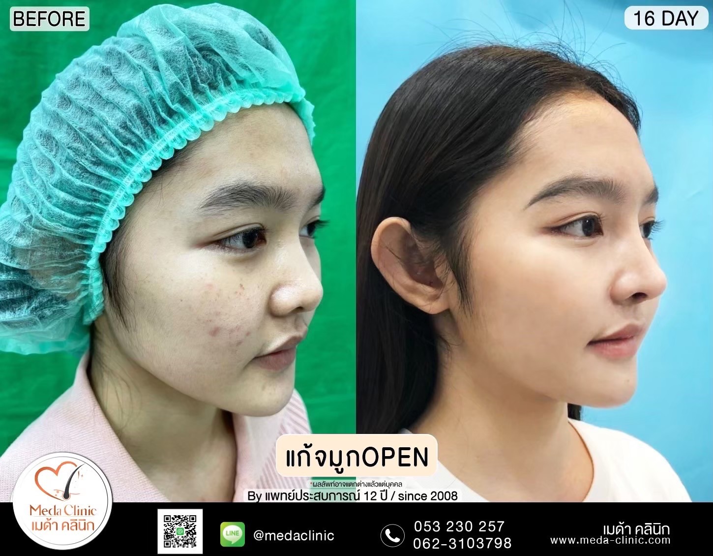 แก้จมูกที่ไหนดี ?