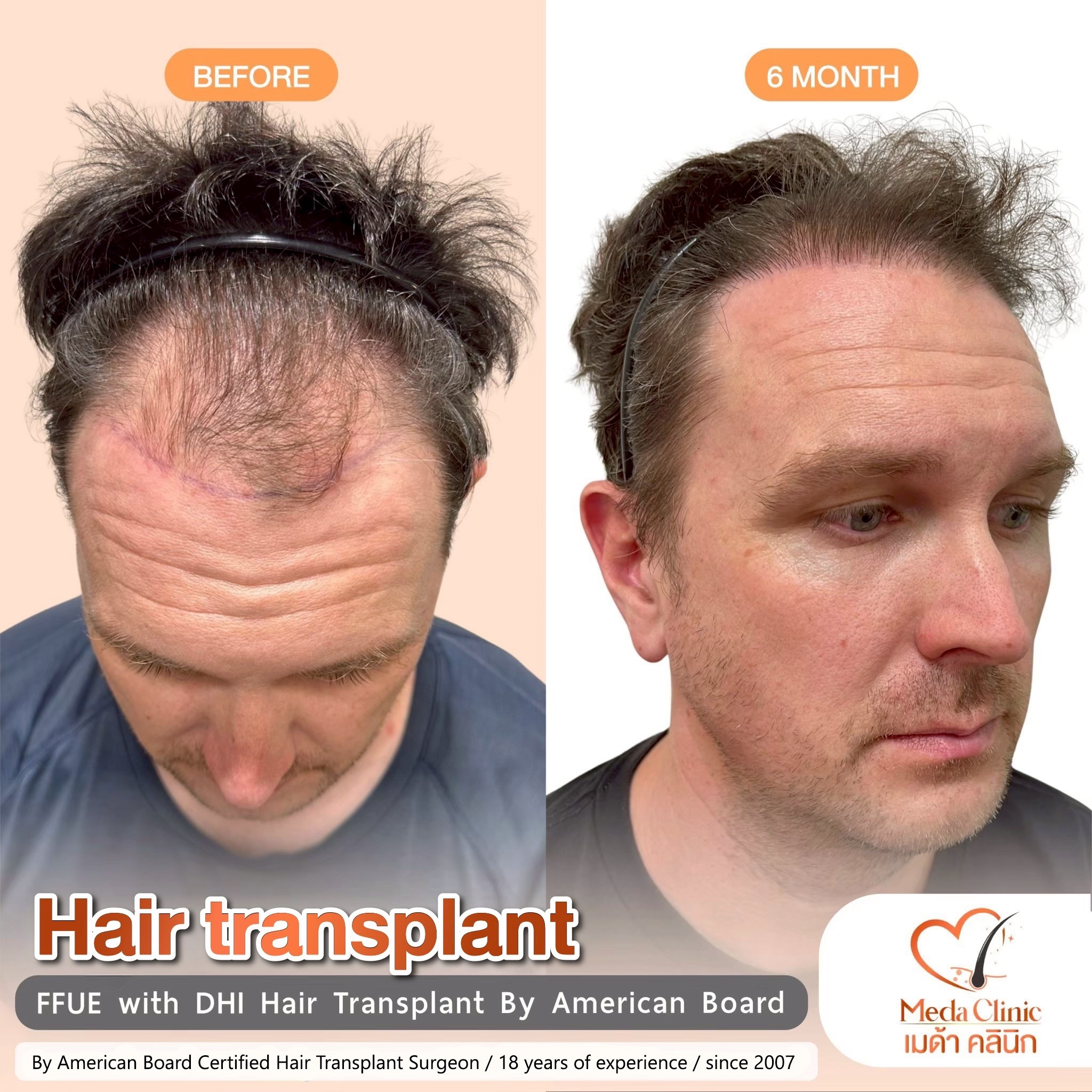 FUE Hair transplant