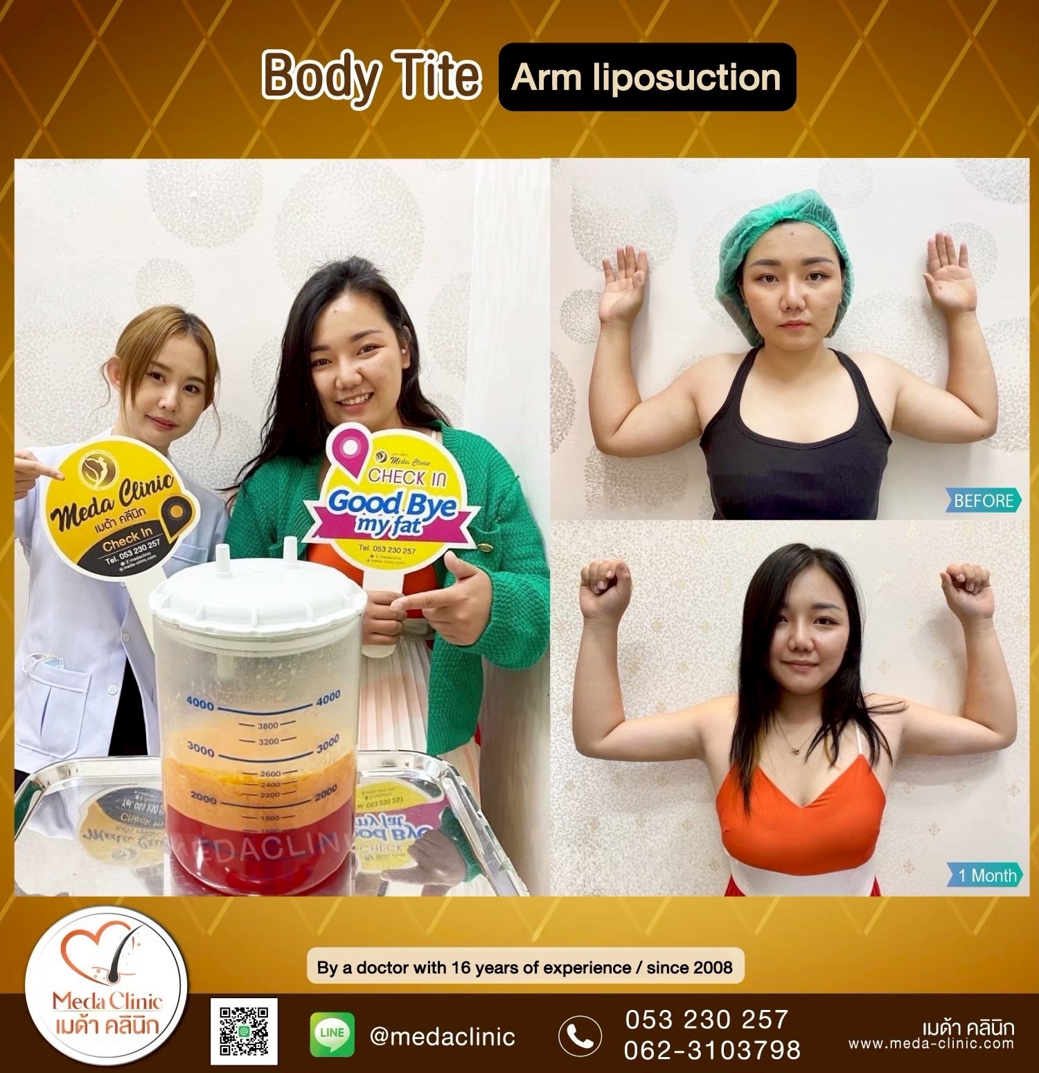 liposuction clinic