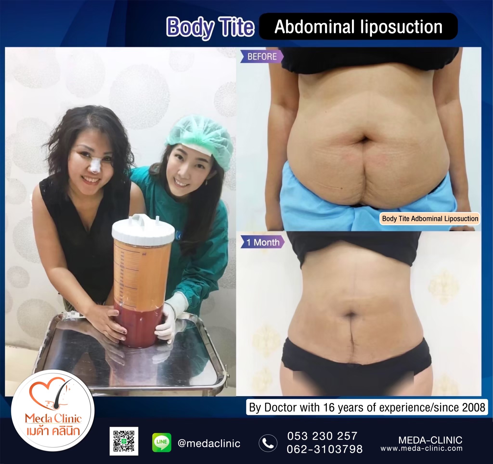 liposuction clinic