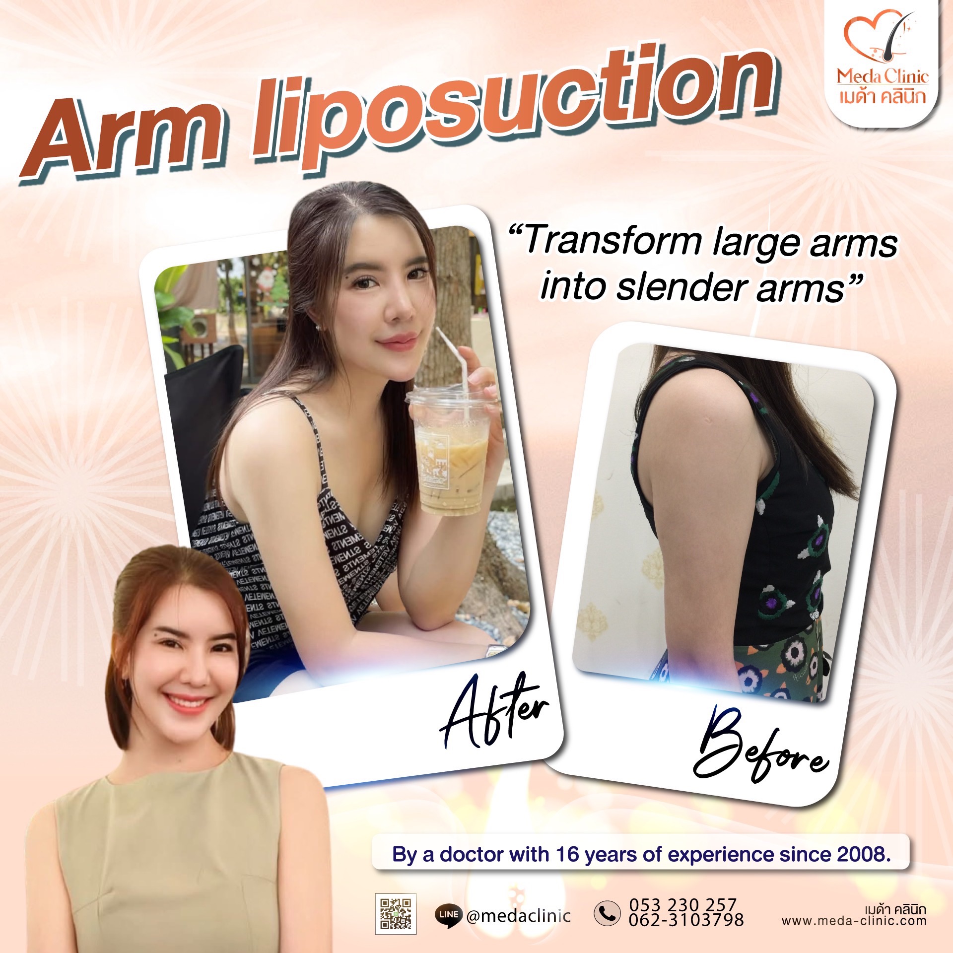 liposuction
