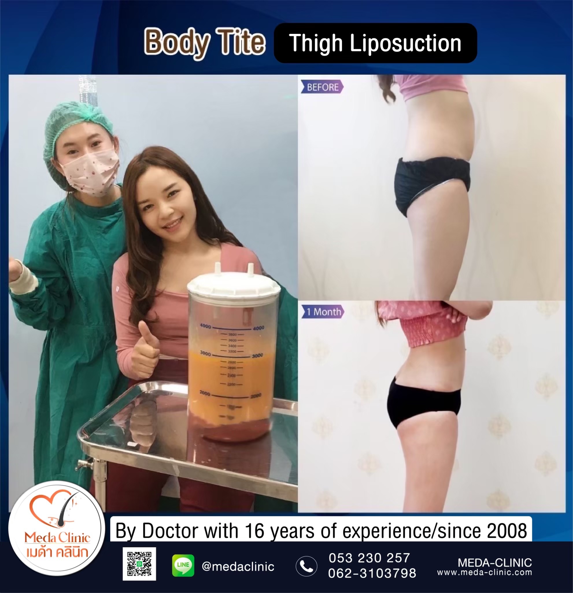 The best liposuction clinic