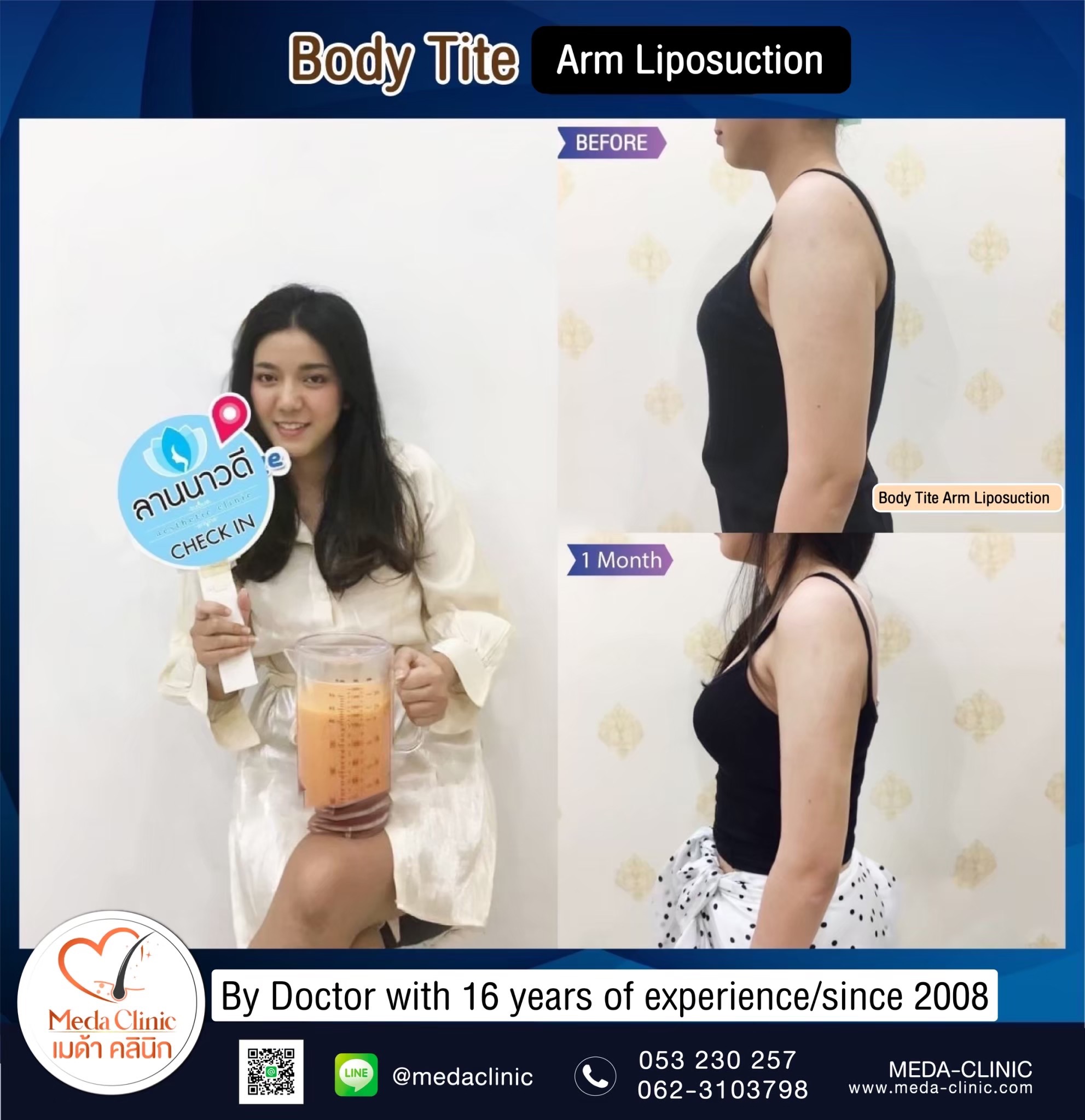 The best liposuction clinic