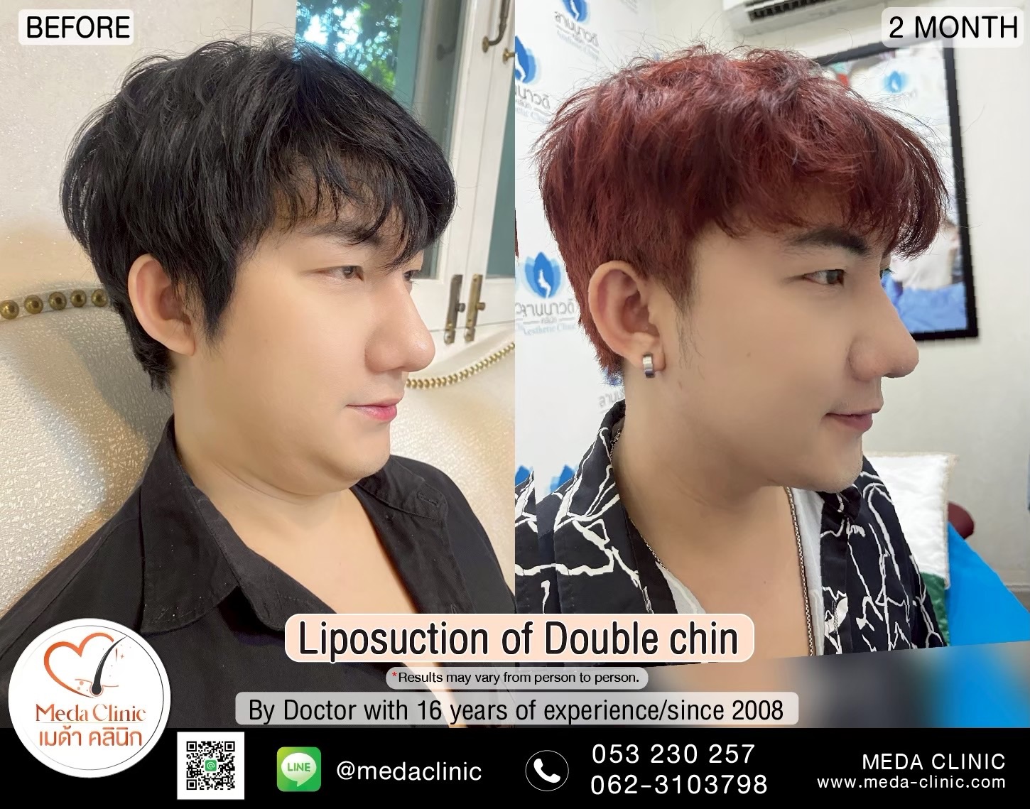 The best liposuction clinic