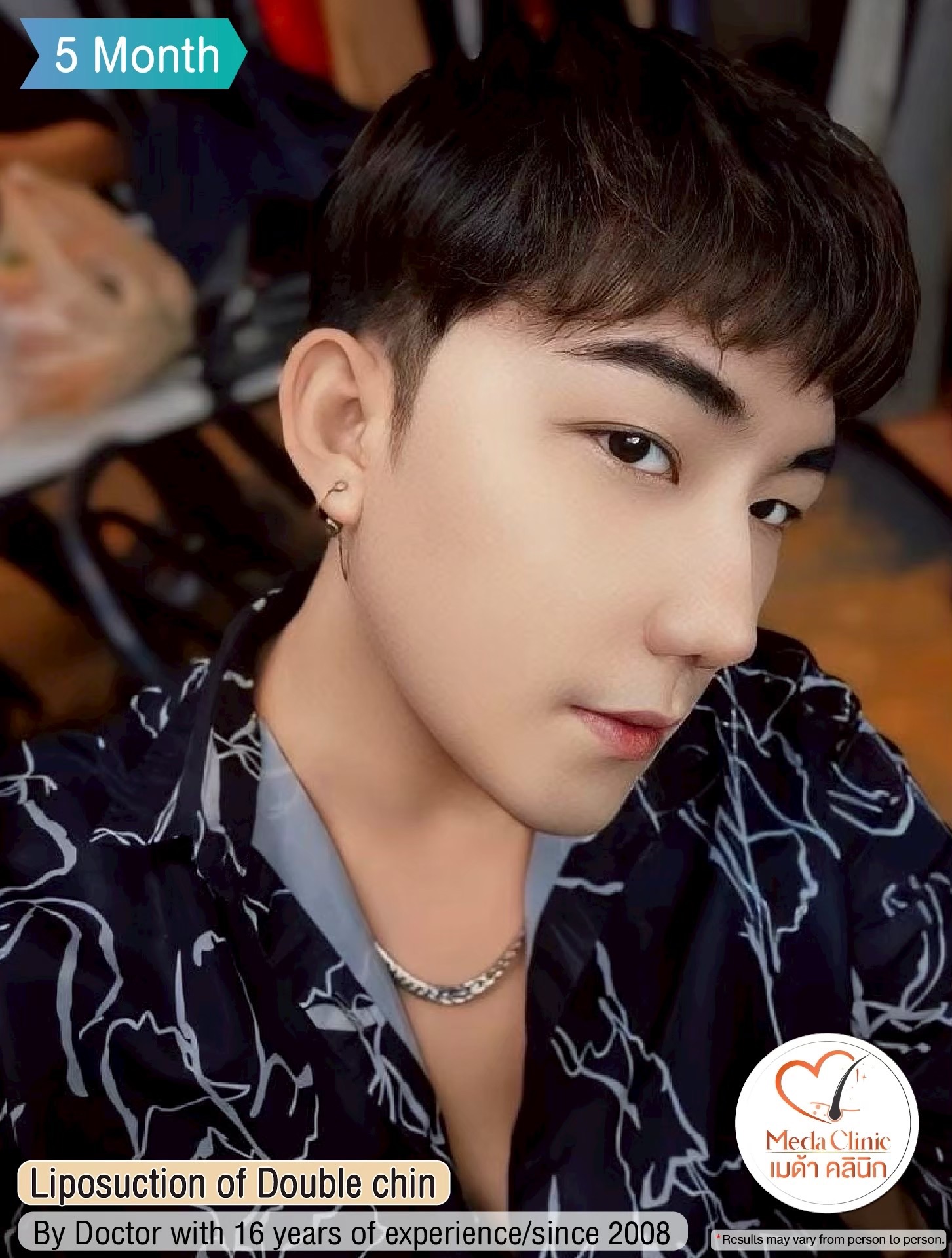 Where should I go for liposuction?