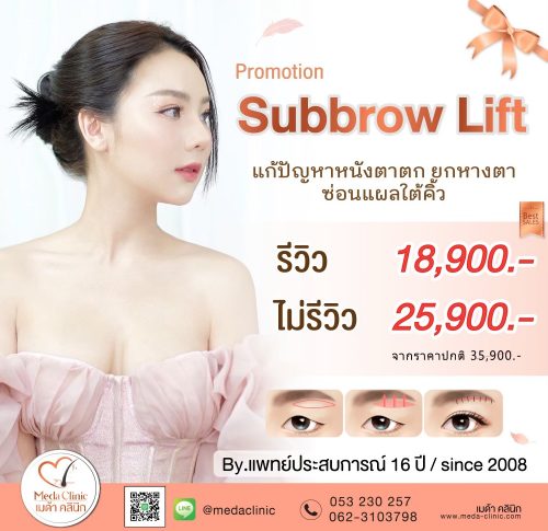 ผ่าตัดยกคิ้วเชียงใหม่